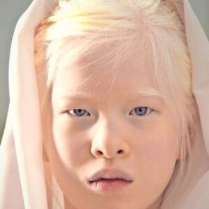 Girl abandoned by parents for her looks wants to prove the world wrong – now she models for Vogue